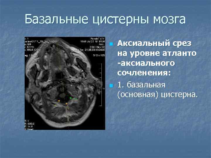 Базальные цистерны мозга n n Аксиальный срез на уровне атланто -аксиального сочленения: 1. базальная