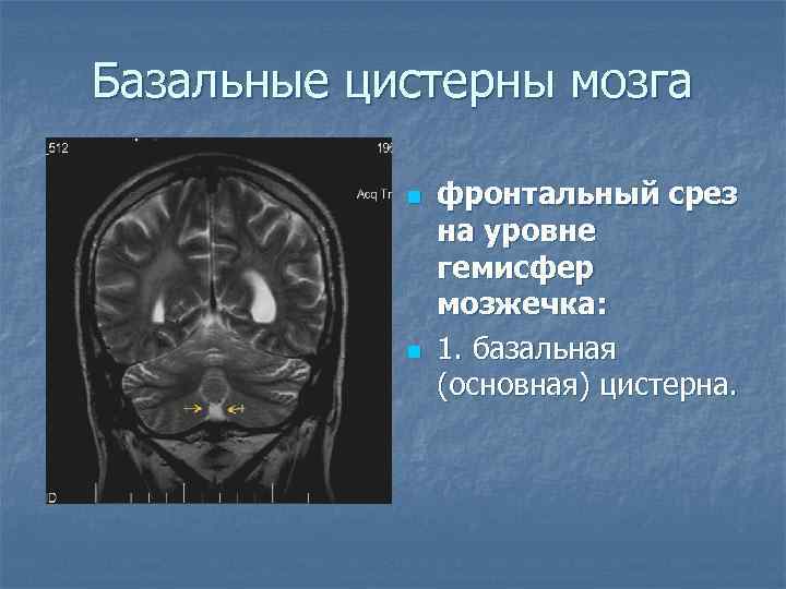 Базальные цистерны мозга n n фронтальный срез на уровне гемисфер мозжечка: 1. базальная (основная)