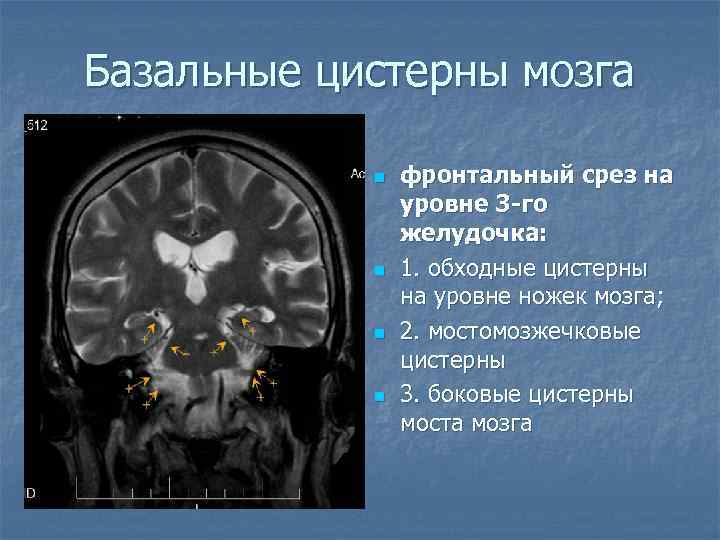 Базальные цистерны мозга n n фронтальный срез на уровне 3 -го желудочка: 1. обходные