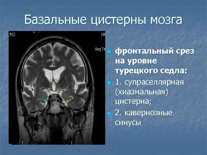 Базальные цистерны мозга n n n фронтальный срез на уровне турецкого седла: 1. супраселлярная