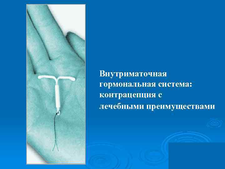 Внутриматочная гормональная система: контрацепция с лечебными преимуществами Январь 2005 