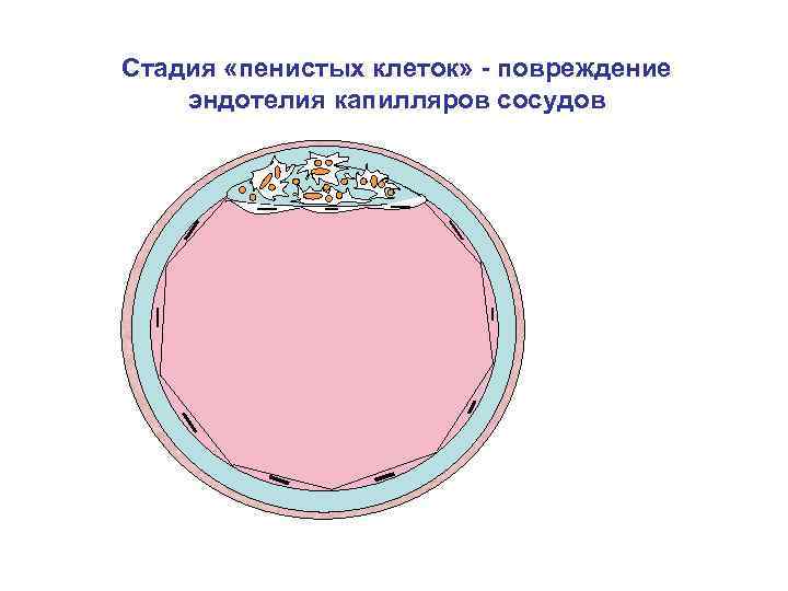 Стадия «пенистых клеток» - повреждение эндотелия капилляров сосудов 
