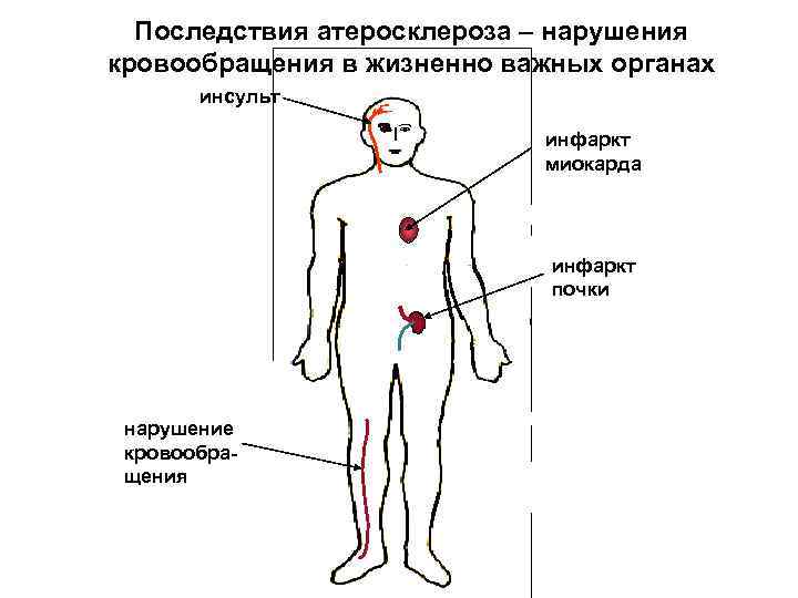 Последствия атеросклероза – нарушения кровообращения в жизненно важных органах инсульт • • инфаркт миокарда