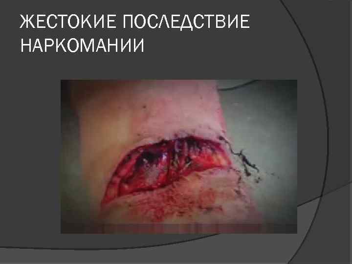 ЖЕСТОКИЕ ПОСЛЕДСТВИЕ НАРКОМАНИИ 