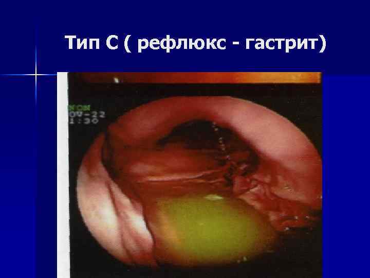 Тип С ( рефлюкс - гастрит) 