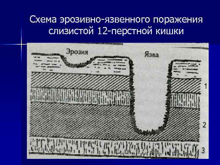 Схема эрозивно-язвенного поражения слизистой 12 -перстной кишки 