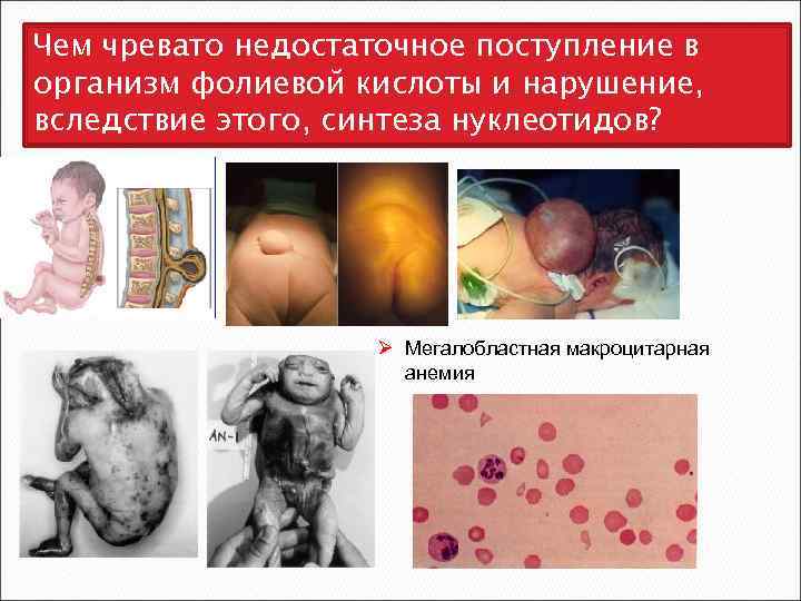 Чем чревато недостаточное поступление в организм фолиевой кислоты и нарушение, вследствие этого, синтеза нуклеотидов?