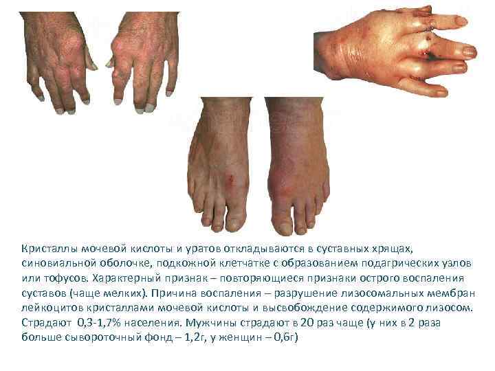 Кристаллы мочевой кислоты и уратов откладываются в суставных хрящах, синовиальной оболочке, подкожной клетчатке с