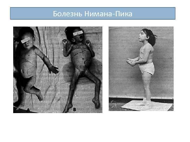 Болезнь Нимана-Пика 