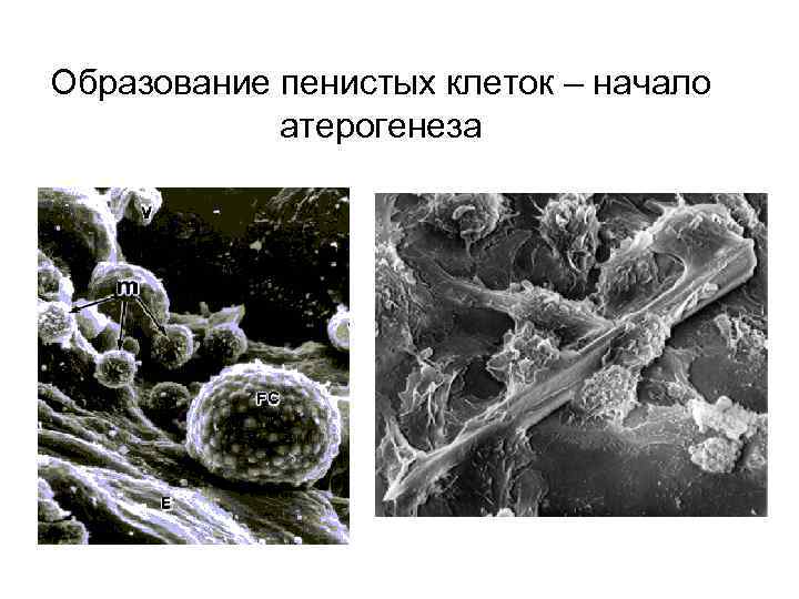 Образование пенистых клеток – начало атерогенеза 