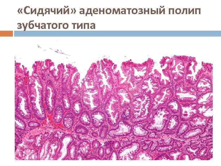  «Сидячий» аденоматозный полип зубчатого типа 