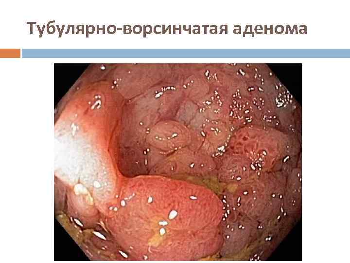 Тубулярно-ворсинчатая аденома 