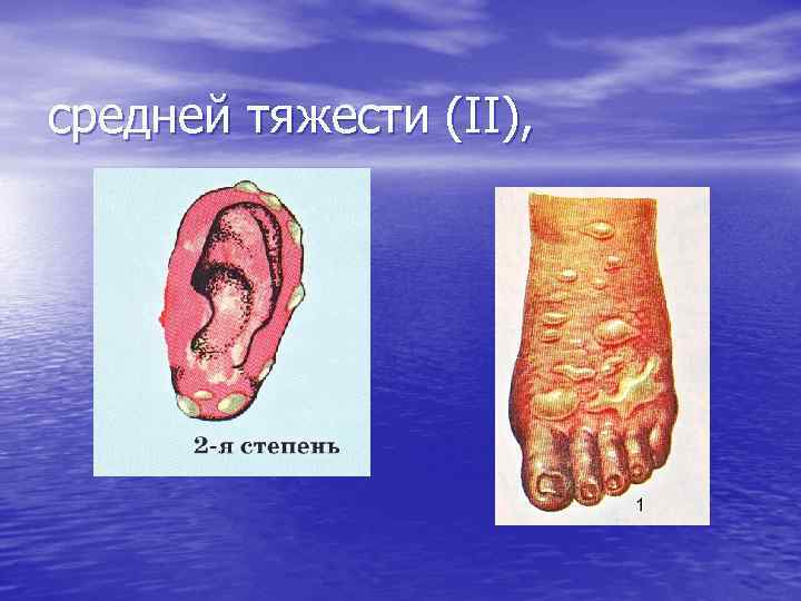 средней тяжести (II), 