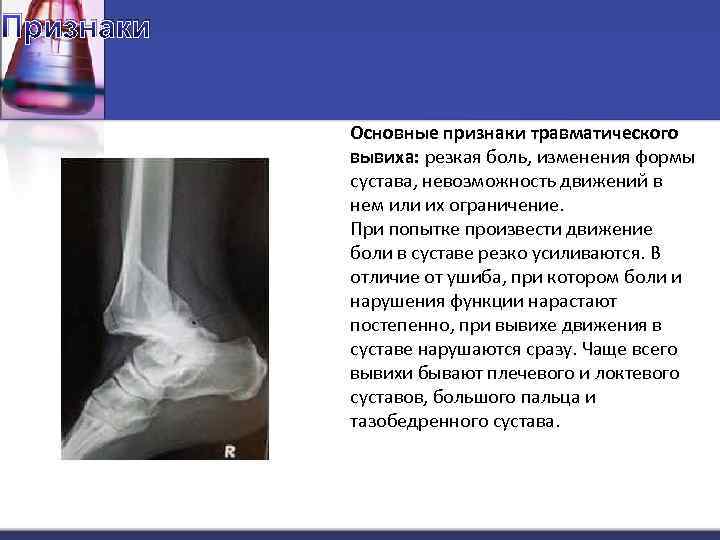 Признаки Основные признаки травматического вывиха: резкая боль, изменения формы сустава, невозможность движений в нем