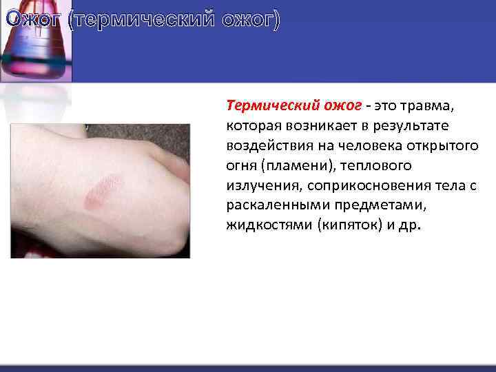 Ожог (термический ожог) Термический ожог - это травма, которая возникает в результате воздействия на