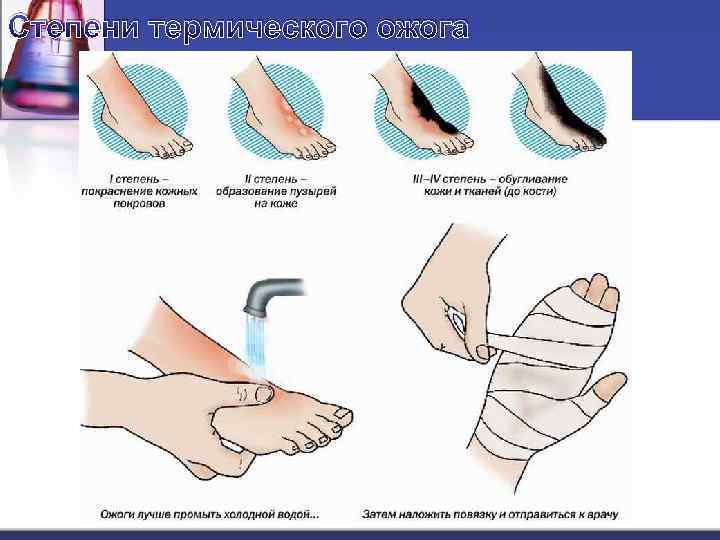 Степени термического ожога 