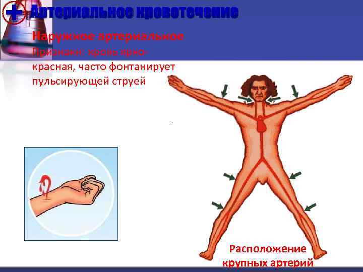 + Наружное артериальное Артериальное кровотечение Признаки: кровь яркокрасная, часто фонтанирует пульсирующей струей Расположение крупных