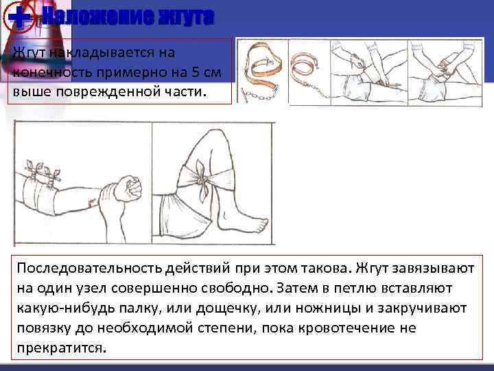 + Наложение жгута Жгут накладывается на конечность примерно на 5 см выше поврежденной части.
