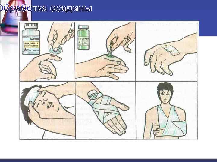 Обработка ссадины 