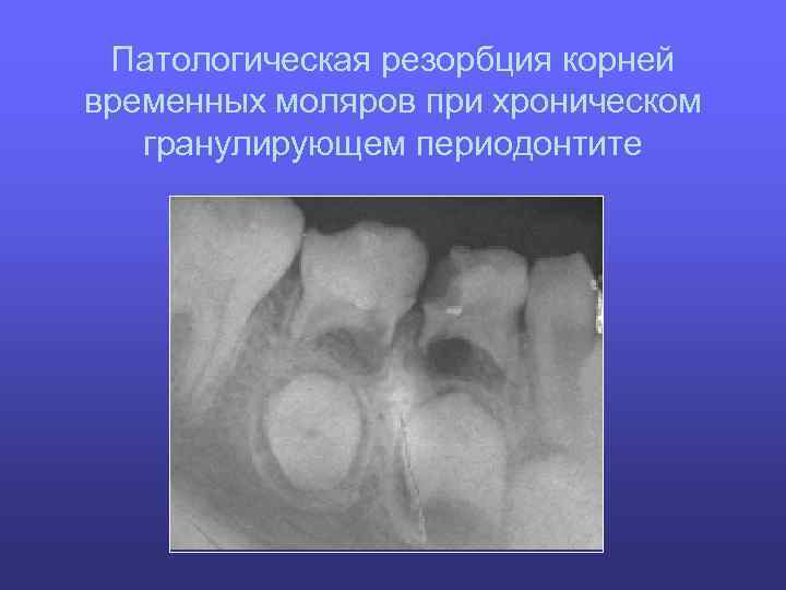Патологическая резорбция корней временных моляров при хроническом гранулирующем периодонтите 