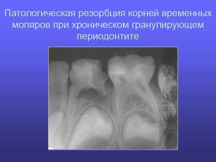 Патологическая резорбция корней временных моляров при хроническом гранулирующем периодонтите 
