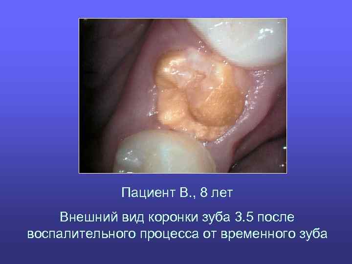 Пациент В. , 8 лет Внешний вид коронки зуба 3. 5 после воспалительного процесса