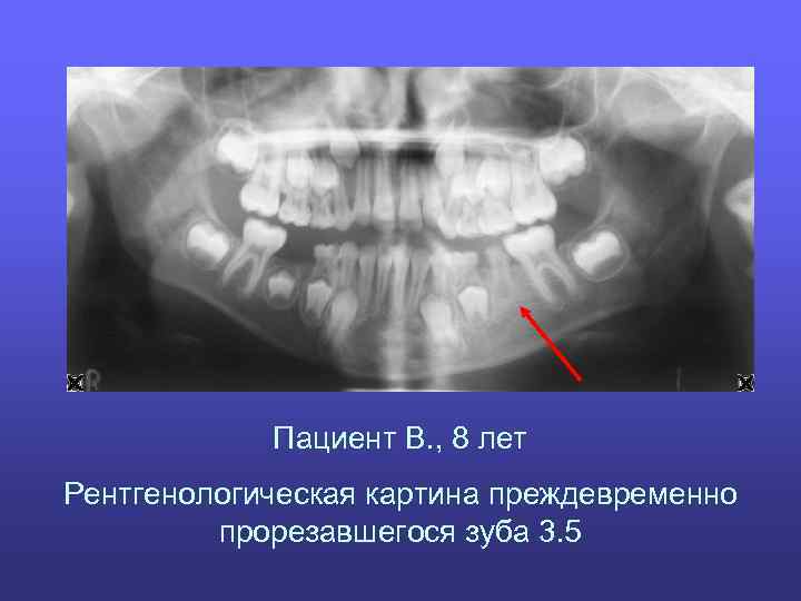 Пациент В. , 8 лет Рентгенологическая картина преждевременно прорезавшегося зуба 3. 5 