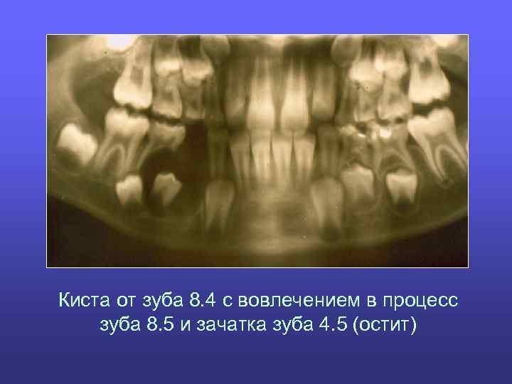 Киста от зуба 8. 4 с вовлечением в процесс зуба 8. 5 и зачатка