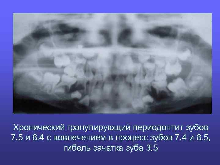 Хронический гранулирующий периодонтит зубов 7. 5 и 8. 4 с вовлечением в процесс зубов