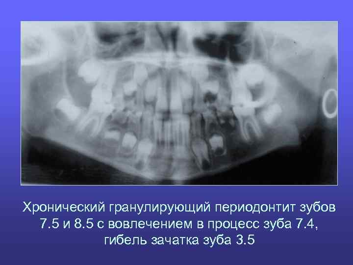Хронический гранулирующий периодонтит зубов 7. 5 и 8. 5 с вовлечением в процесс зуба