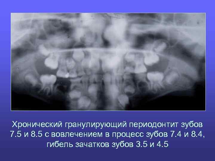 Хронический гранулирующий периодонтит зубов 7. 5 и 8. 5 с вовлечением в процесс зубов