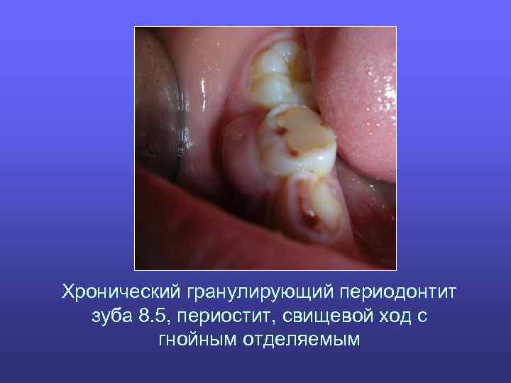Хронический гранулирующий периодонтит зуба 8. 5, периостит, свищевой ход с гнойным отделяемым 
