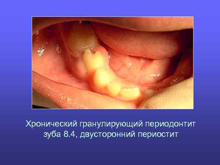 Хронический гранулирующий периодонтит зуба 8. 4, двусторонний периостит 