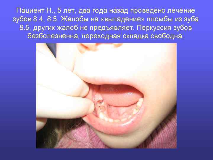 Пациент Н. , 5 лет, два года назад проведено лечение зубов 8. 4, 8.