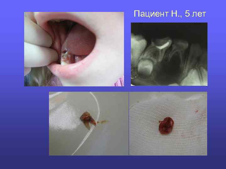 Пациент Н. , 5 лет 