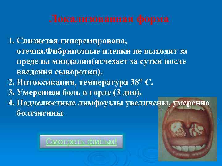 Локализованная форма 1. Слизистая гиперемирована, отечна. Фибринозные пленки не выходят за пределы миндалин(исчезает за
