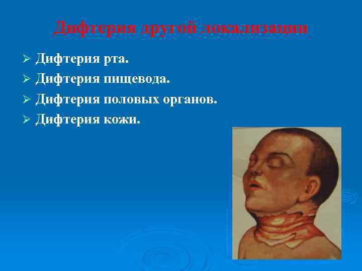 Дифтерия другой локализации Дифтерия рта. Ø Дифтерия пищевода. Ø Дифтерия половых органов. Ø Дифтерия