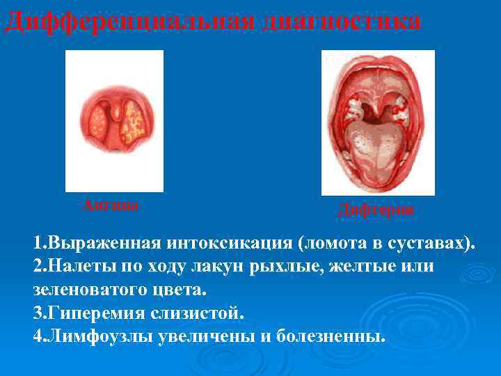 Дифференциальная диагностика Ангина Дифтерия 1. Выраженная интоксикация (ломота в суставах). 2. Налеты по ходу