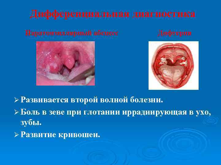 Дифференциальная диагностика Паратонзиллярный абсцесс Дифтерия Ø Развивается второй волной болезни. Ø Боль в зеве