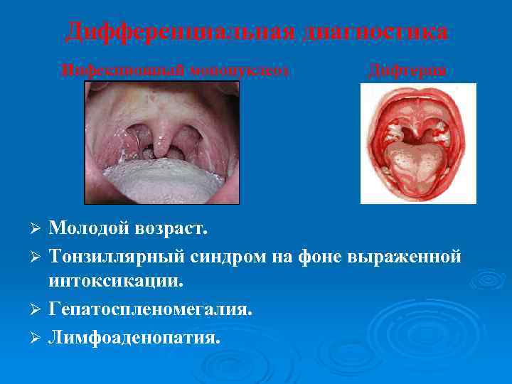 Дифференциальная диагностика Инфекционный мононуклеоз Дифтерия Молодой возраст. Ø Тонзиллярный синдром на фоне выраженной интоксикации.