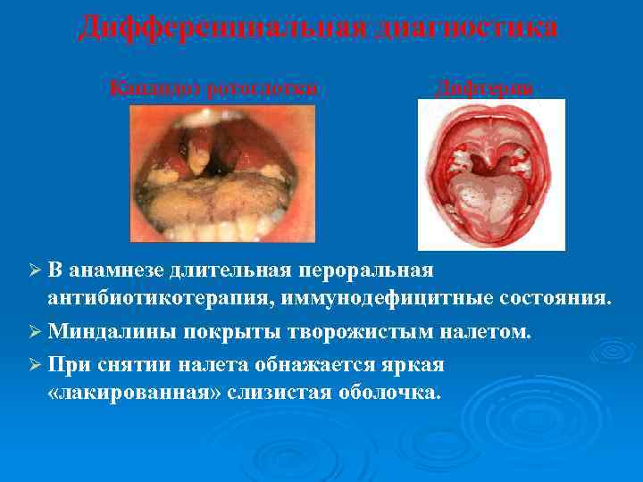 Дифференциальная диагностика Кандидоз ротоглотки Дифтерия Ø В анамнезе длительная пероральная антибиотикотерапия, иммунодефицитные состояния. Ø