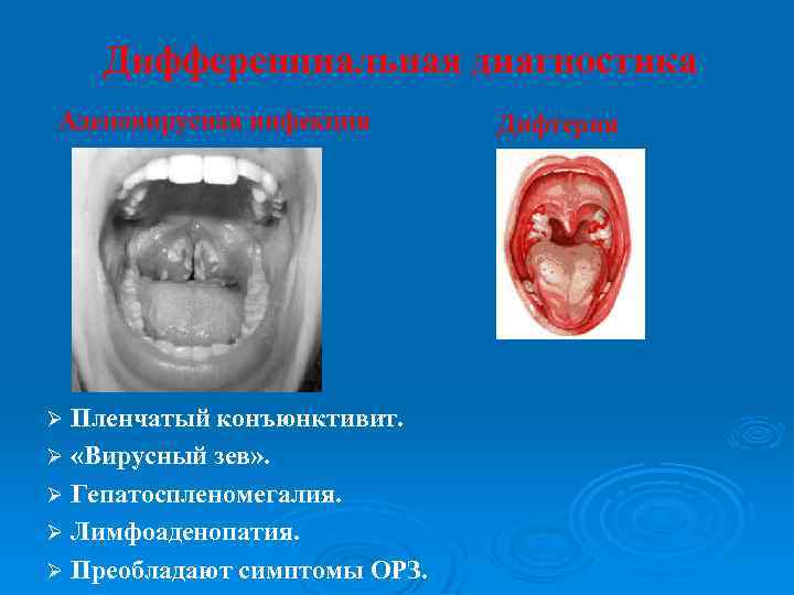 Дифференциальная диагностика Аденовирусная инфекция Ø Пленчатый конъюнктивит. Ø «Вирусный зев» . Ø Гепатоспленомегалия. Ø