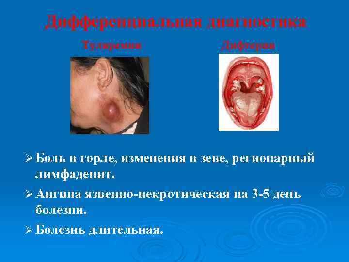 Дифференциальная диагностика Туляремия Дифтерия Ø Боль в горле, изменения в зеве, регионарный лимфаденит. Ø