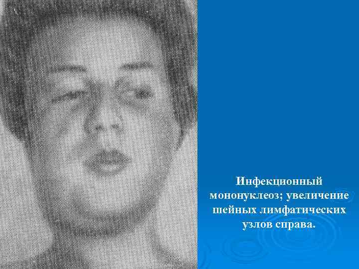 Инфекционный мононуклеоз; увеличение шейных лимфатических узлов справа. 