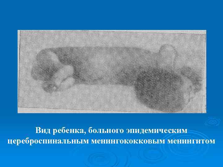 Вид ребенка, больного эпидемическим цереброспинальным менингококковым менингитом 
