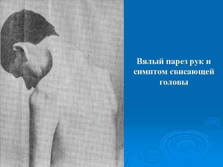 Вялый парез рук и симптом свисающей головы 