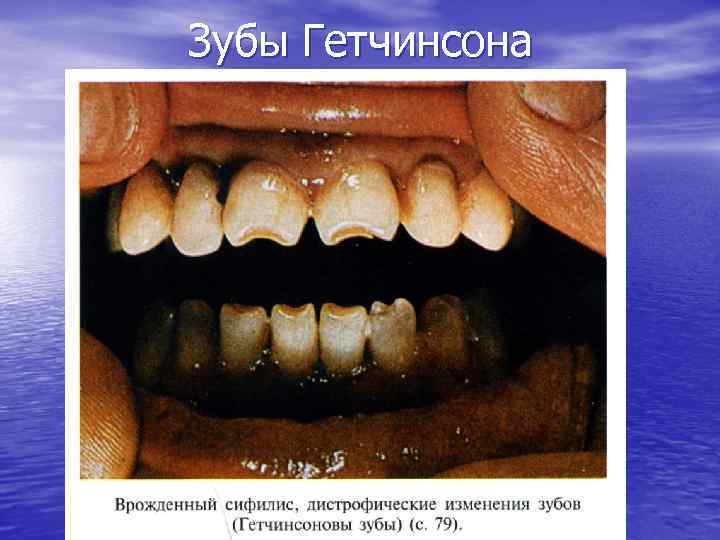 Зубы Гетчинсона 