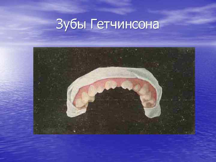 Зубы Гетчинсона 