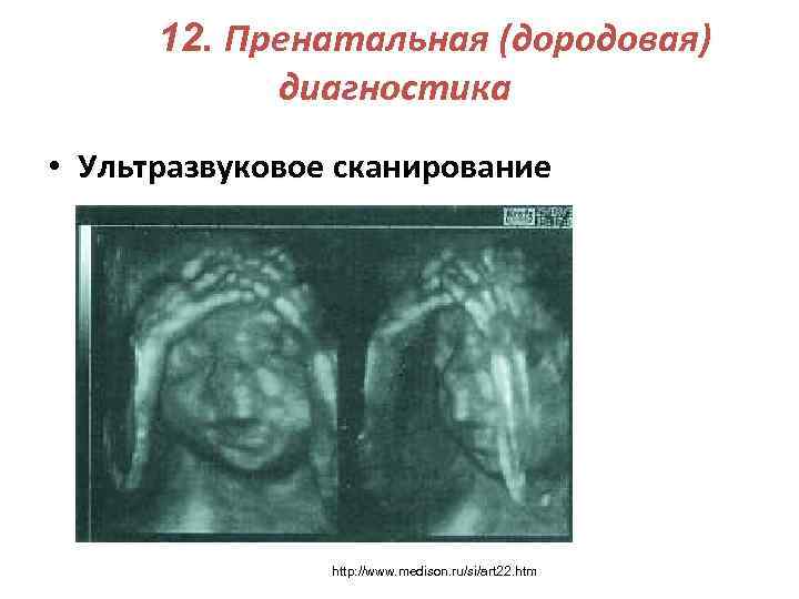 12. Пренатальная (дородовая) диагностика • Ультразвуковое сканирование http: //www. medison. ru/si/art 22. htm 