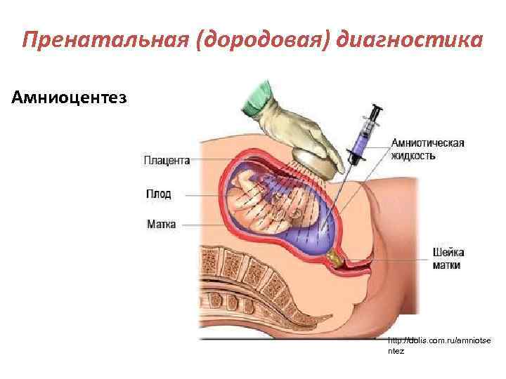 Пренатальная (дородовая) диагностика Амниоцентез http: //dolis. com. ru/amniotse ntez 